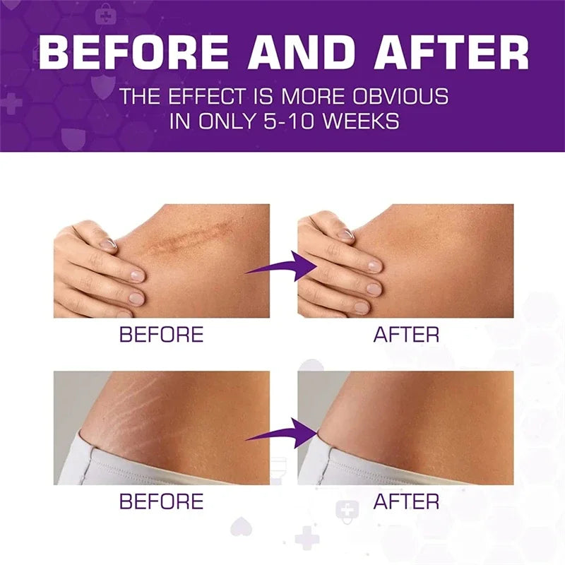 Silicone Scar Sheets