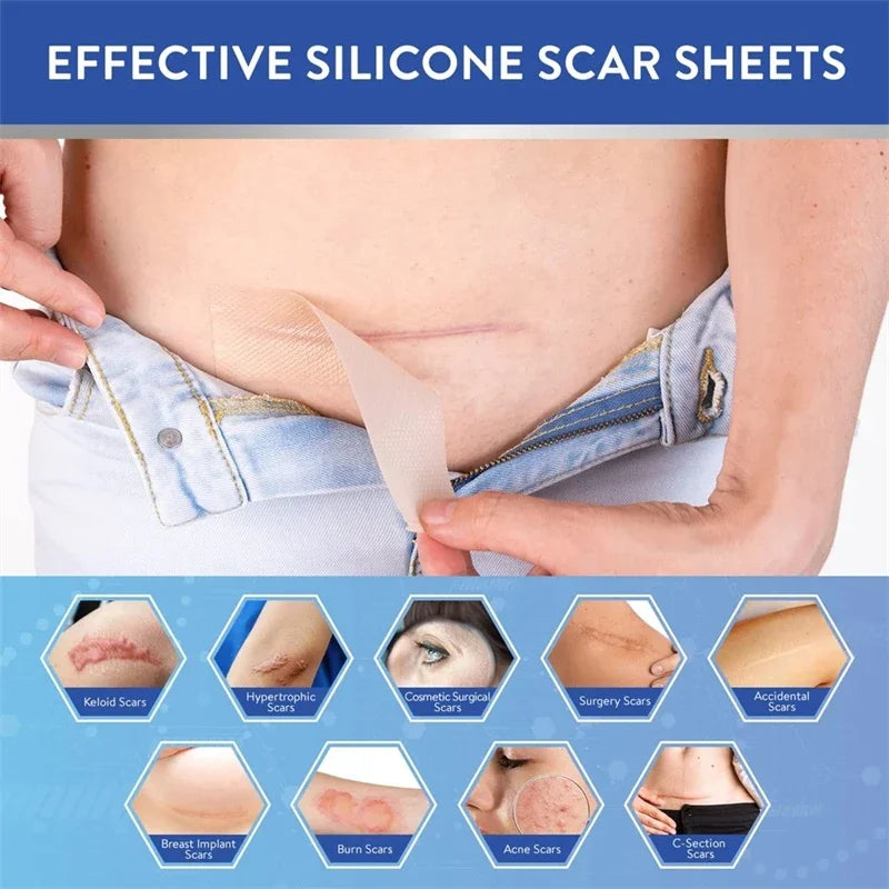 Silicone Scar Sheets
